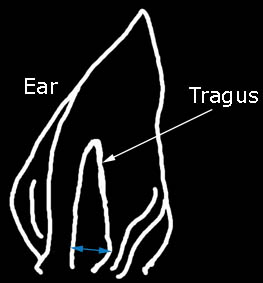 Diagram demonstrating point of measurement of tragus